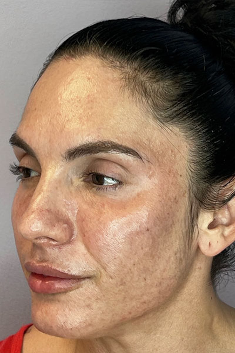 Skin Pen Microneedling Before & After Gallery - Patient 122948958 - Image 3