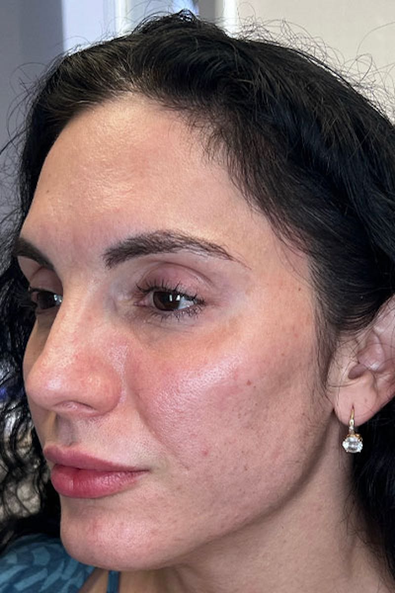 Skin Pen Microneedling Before & After Gallery - Patient 122948958 - Image 4