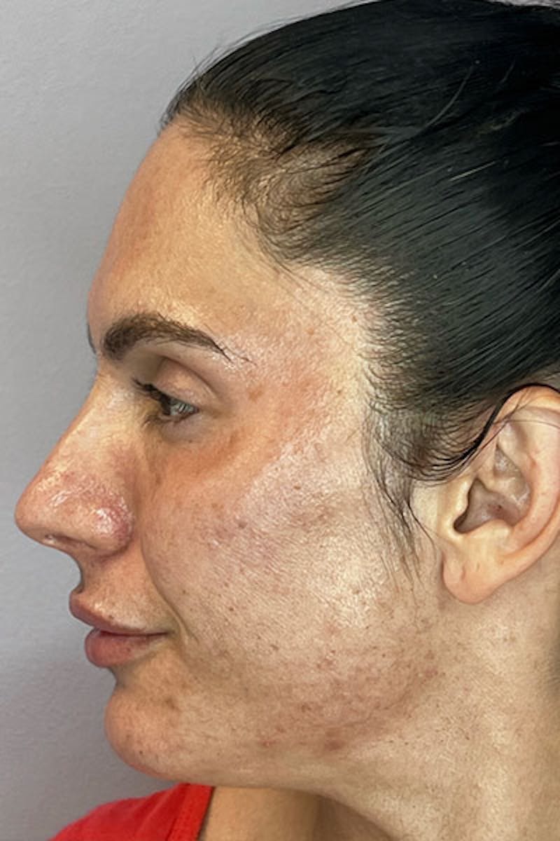Skin Pen Microneedling Before & After Gallery - Patient 122948958 - Image 5