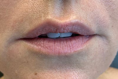 Lip Filler Before & After Gallery - Patient 122948959 - Image 1