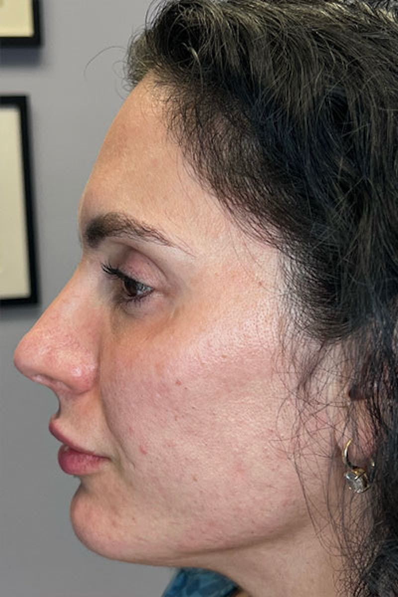Skin Pen Microneedling Before & After Gallery - Patient 122948958 - Image 6