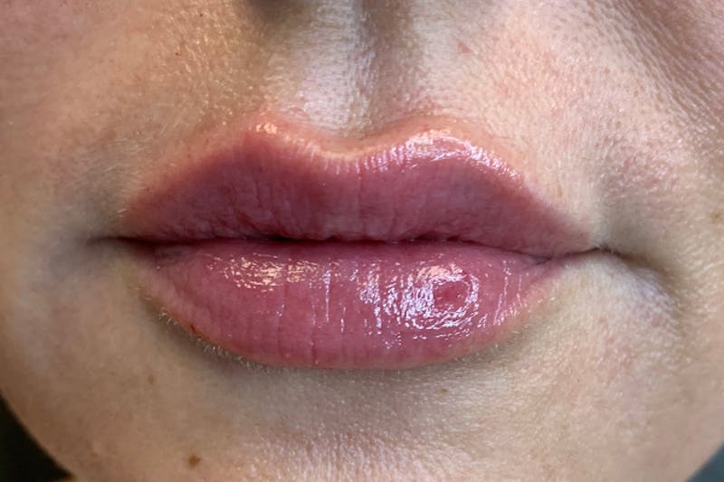 Lip Filler Before & After Gallery - Patient 122948959 - Image 2