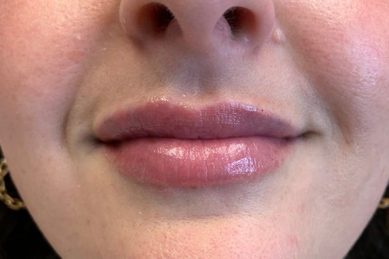 Lip Filler Before & After Gallery - Patient 122948965 - Image 2