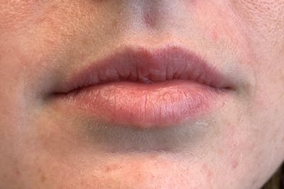 Lip Filler Before & After Gallery - Patient 122948973 - Image 1