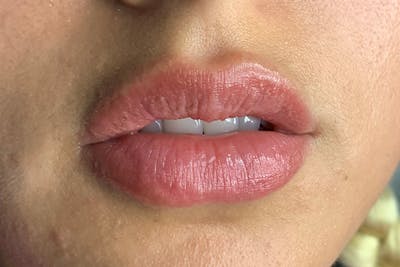 Lip Filler Before & After Gallery - Patient 122949018 - Image 1