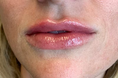 Lip Filler Before & After Gallery - Patient 122949023 - Image 2