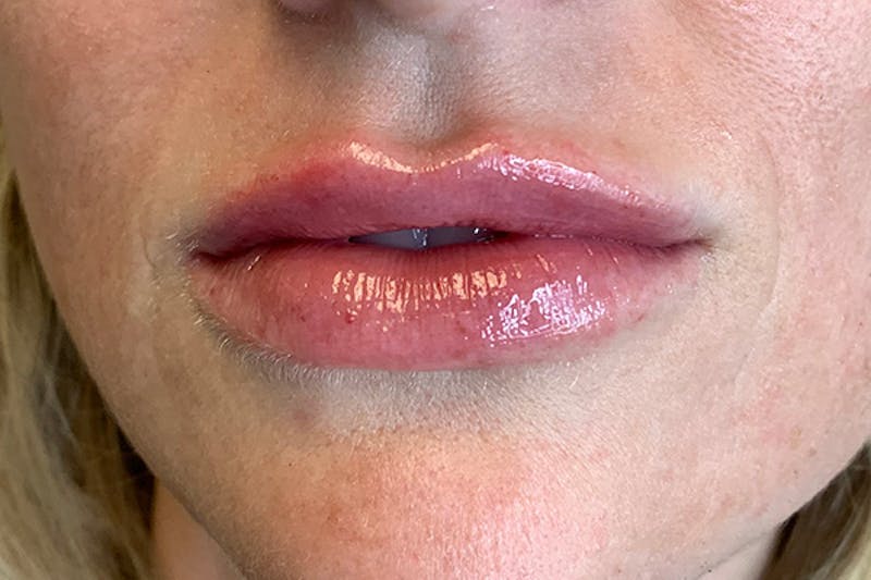 Lip Filler Before & After Gallery - Patient 122949023 - Image 2
