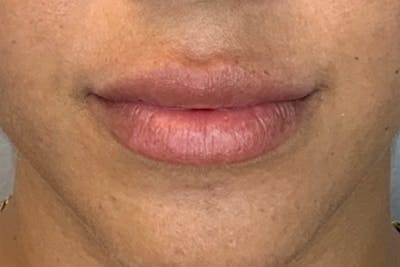 Lip Filler Before & After Gallery - Patient 122949030 - Image 2