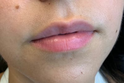 Lip Filler Before & After Gallery - Patient 122949062 - Image 1