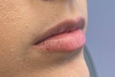 Lip Filler Before & After Gallery - Patient 122949075 - Image 1