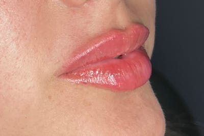 Lip Filler Before & After Gallery - Patient 122949075 - Image 2