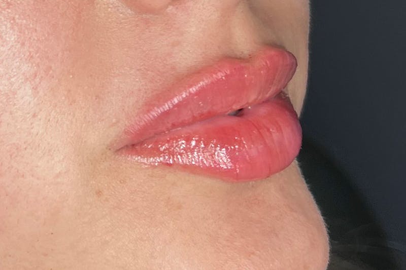 Lip Filler Before & After Gallery - Patient 122949075 - Image 2