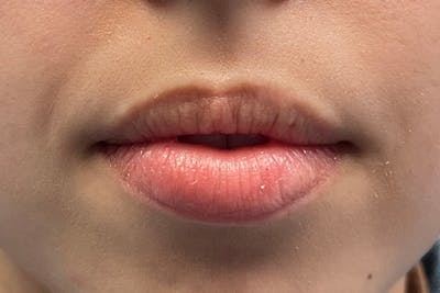 Lip Filler Before & After Gallery - Patient 123125265 - Image 1