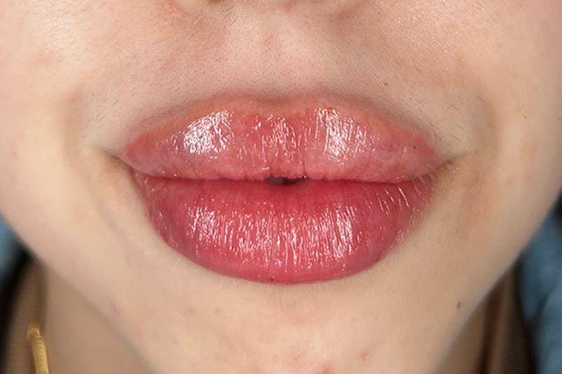 Lip Filler Before & After Gallery - Patient 123125265 - Image 2