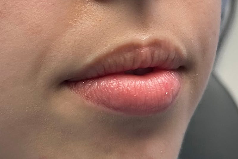 Lip Filler Before & After Gallery - Patient 123125265 - Image 3