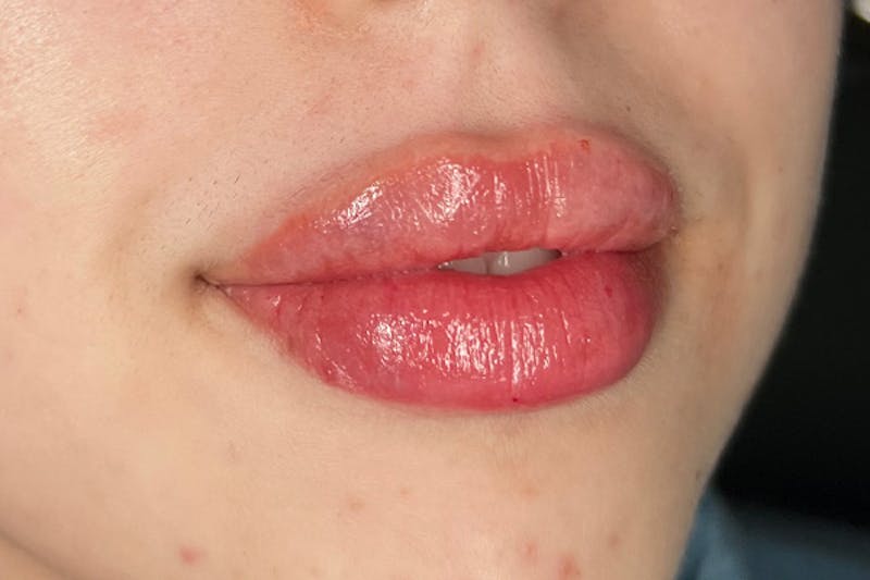 Lip Filler Before & After Gallery - Patient 123125265 - Image 4