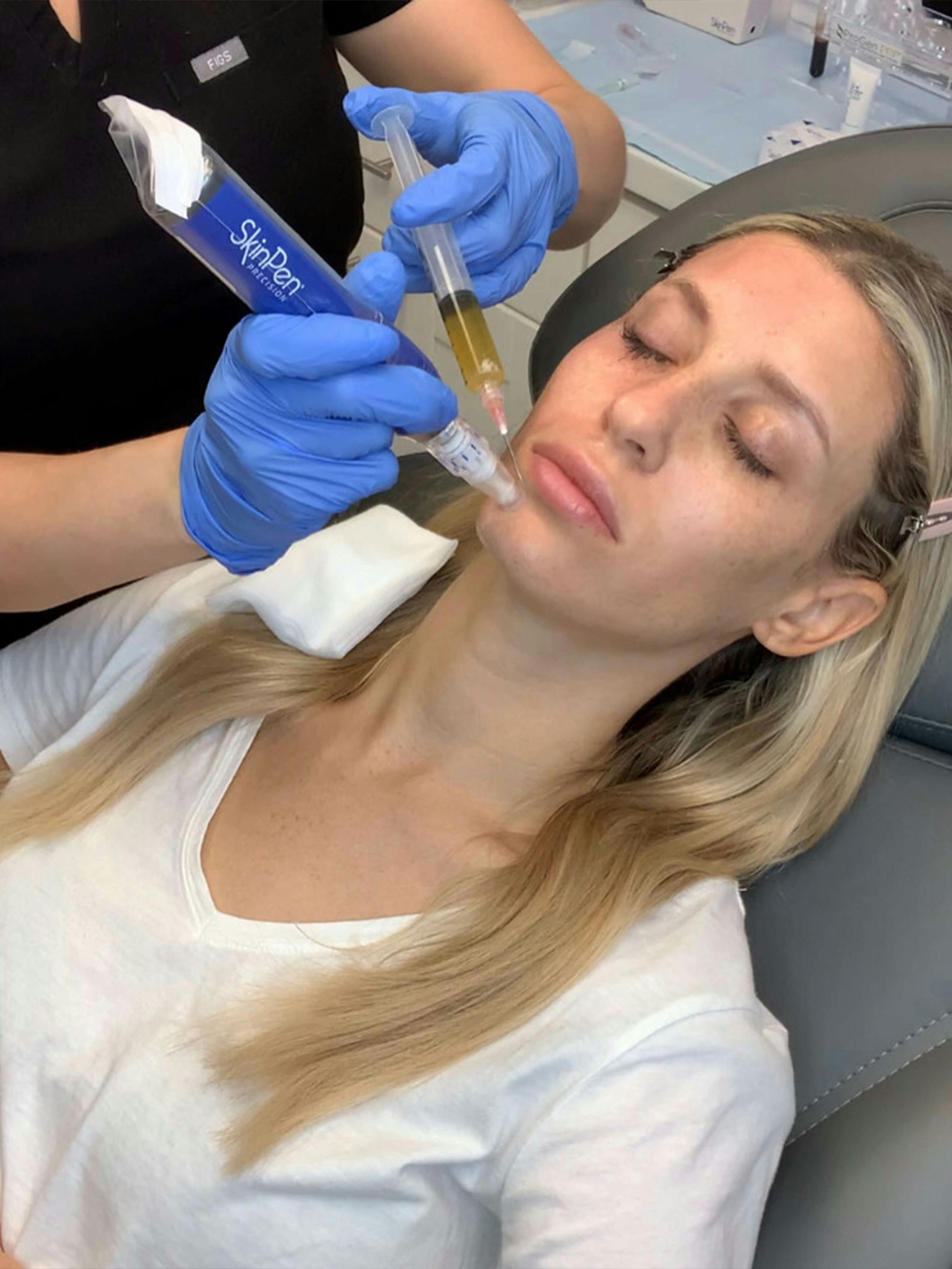 woman getting acne treatment with SkinPen