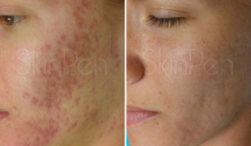 acne treatment results