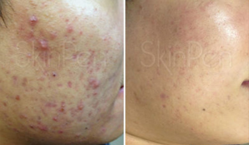 acne treatment results