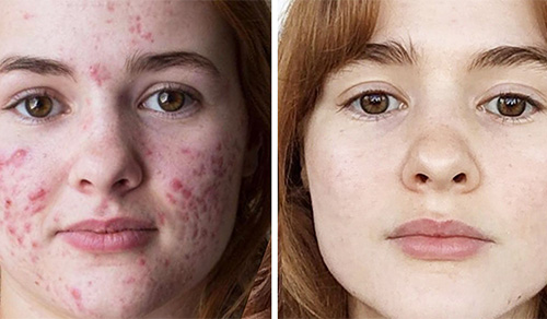 acne treatment results