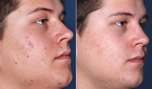 acne treatment results