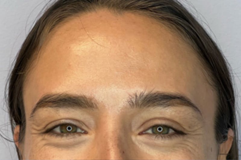 BOTOX Before & After Gallery - Patient 132847415 - Image 3