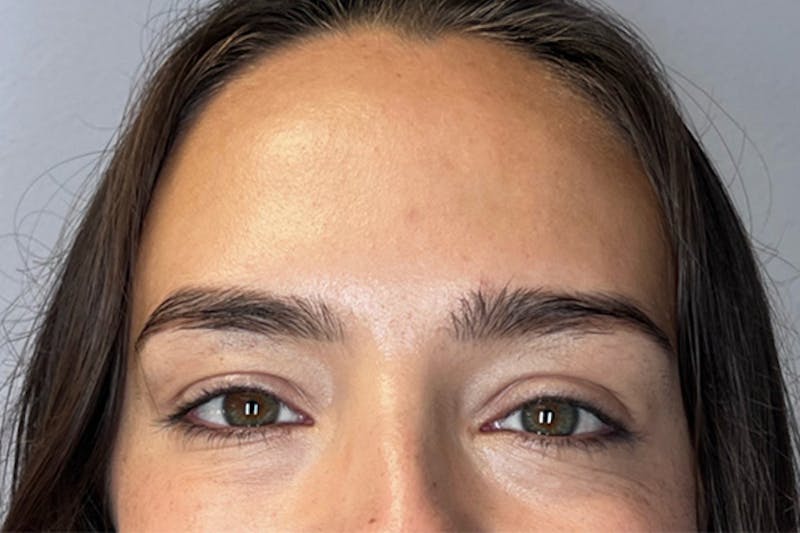 BOTOX Before & After Gallery - Patient 132847415 - Image 4