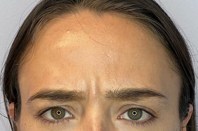 BOTOX Before & After Gallery - Patient 132847415 - Image 5