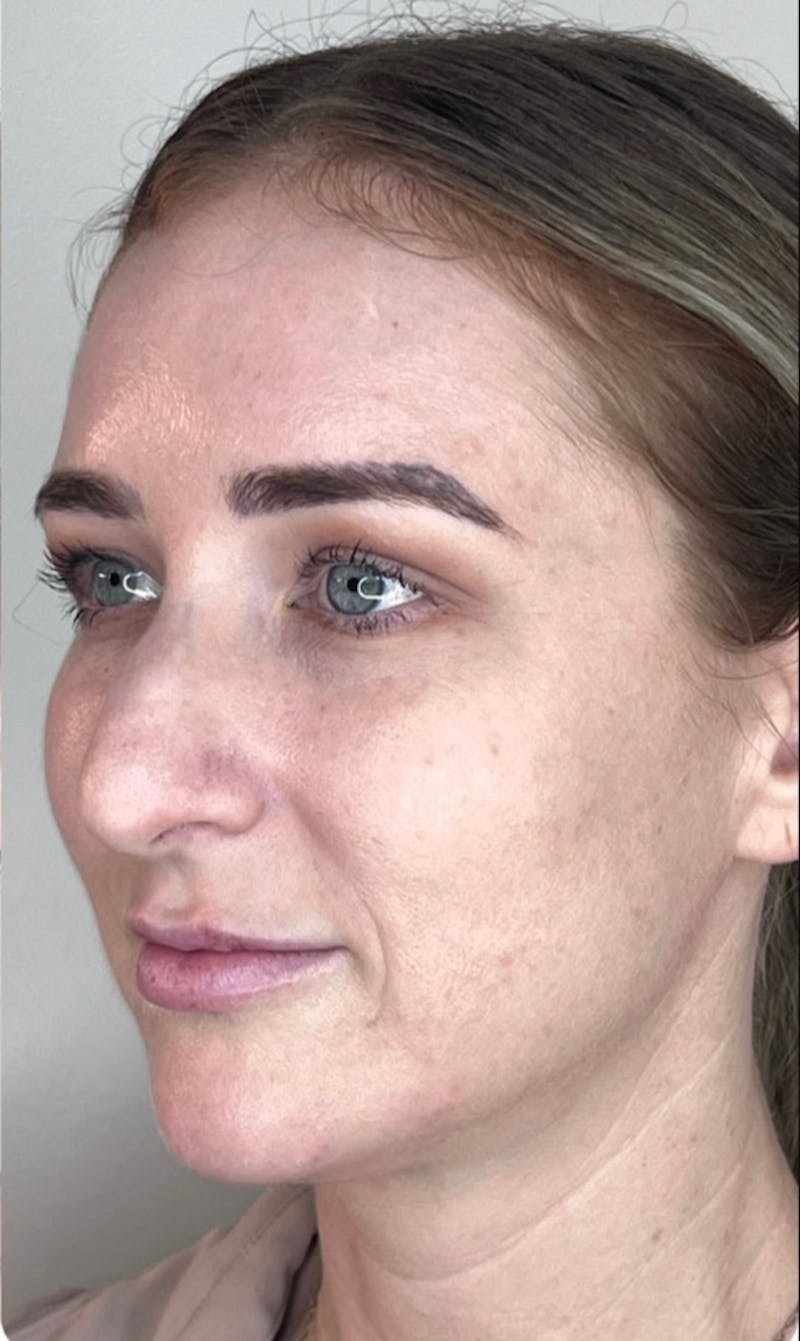 Facial Filler Before & After Gallery - Patient 133049236 - Image 4