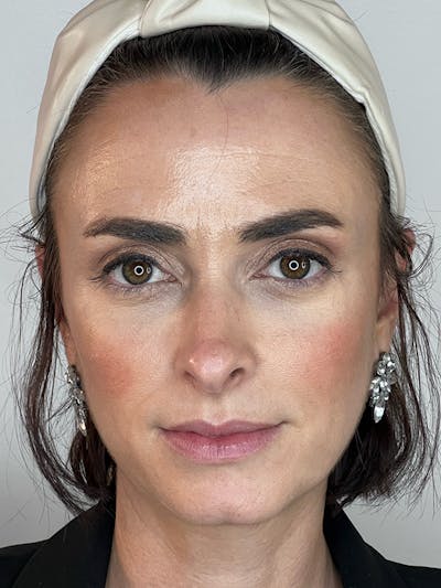 Facial Filler Before & After Gallery - Patient 133049305 - Image 1