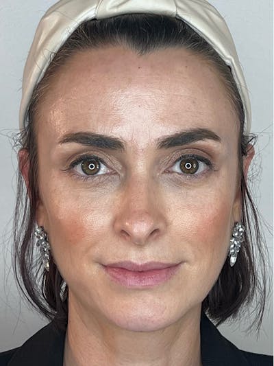 Facial Filler Before & After Gallery - Patient 133049305 - Image 2