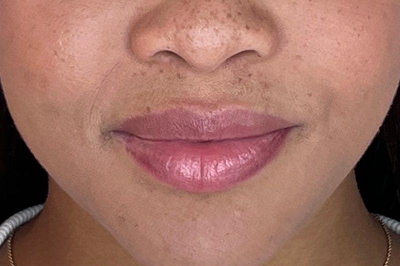 Lip Filler Before & After Gallery - Patient 133419160 - Image 1