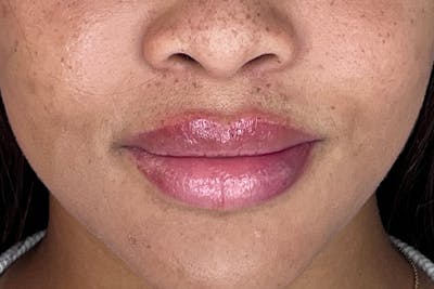 Lip Filler Before & After Gallery - Patient 133419160 - Image 2