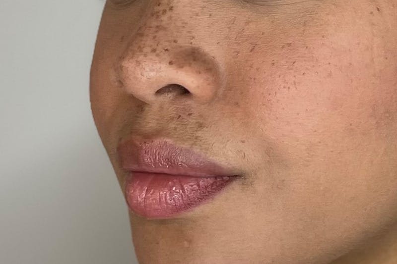 Lip Filler Before & After Gallery - Patient 133419160 - Image 3