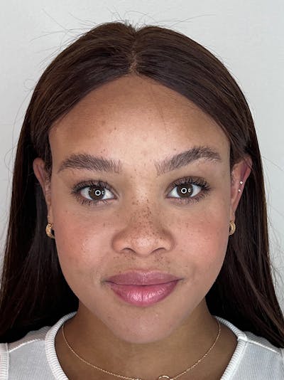 Facial Filler Before & After Gallery - Patient 133419221 - Image 1