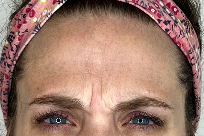BOTOX Before & After Gallery - Patient 133420534 - Image 3