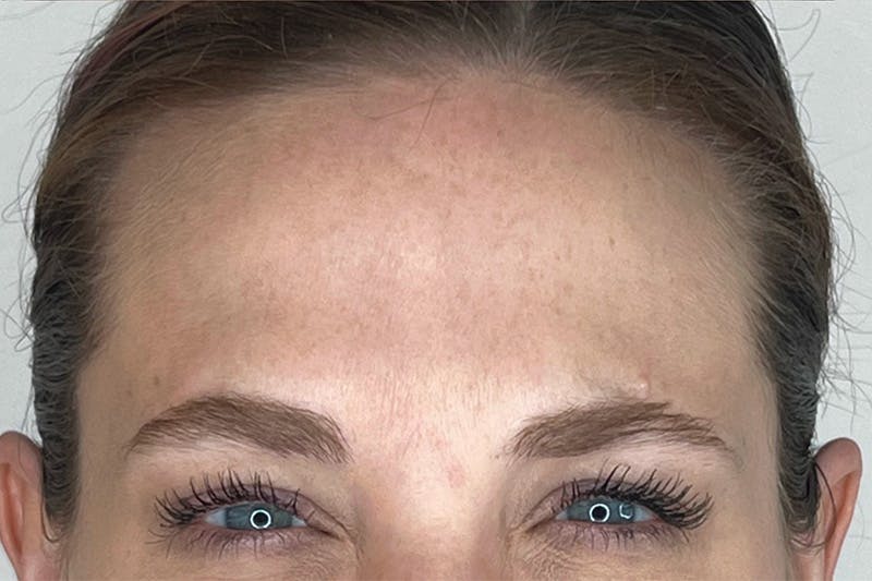 BOTOX Before & After Gallery - Patient 133420534 - Image 4
