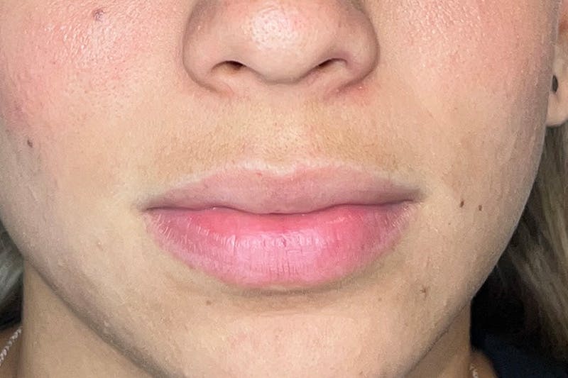 Lip Filler Before & After Gallery - Patient 133475300 - Image 1
