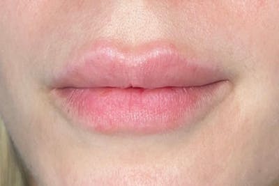 Lip Filler Before & After Gallery - Patient 133475315 - Image 1