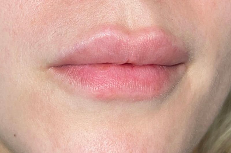 Lip Filler Before & After Gallery - Patient 133475315 - Image 3