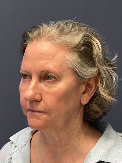 Neck Lift Before & After Gallery - Patient 133574416 - Image 1