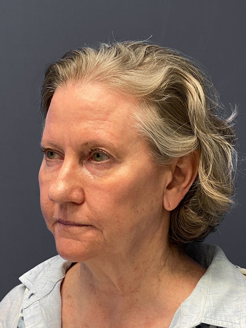 Neck Lift Before & After Gallery - Patient 133574416 - Image 3