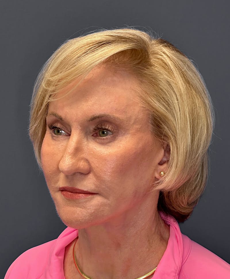 Facelift Before & After Gallery - Patient 122921368 - Image 4