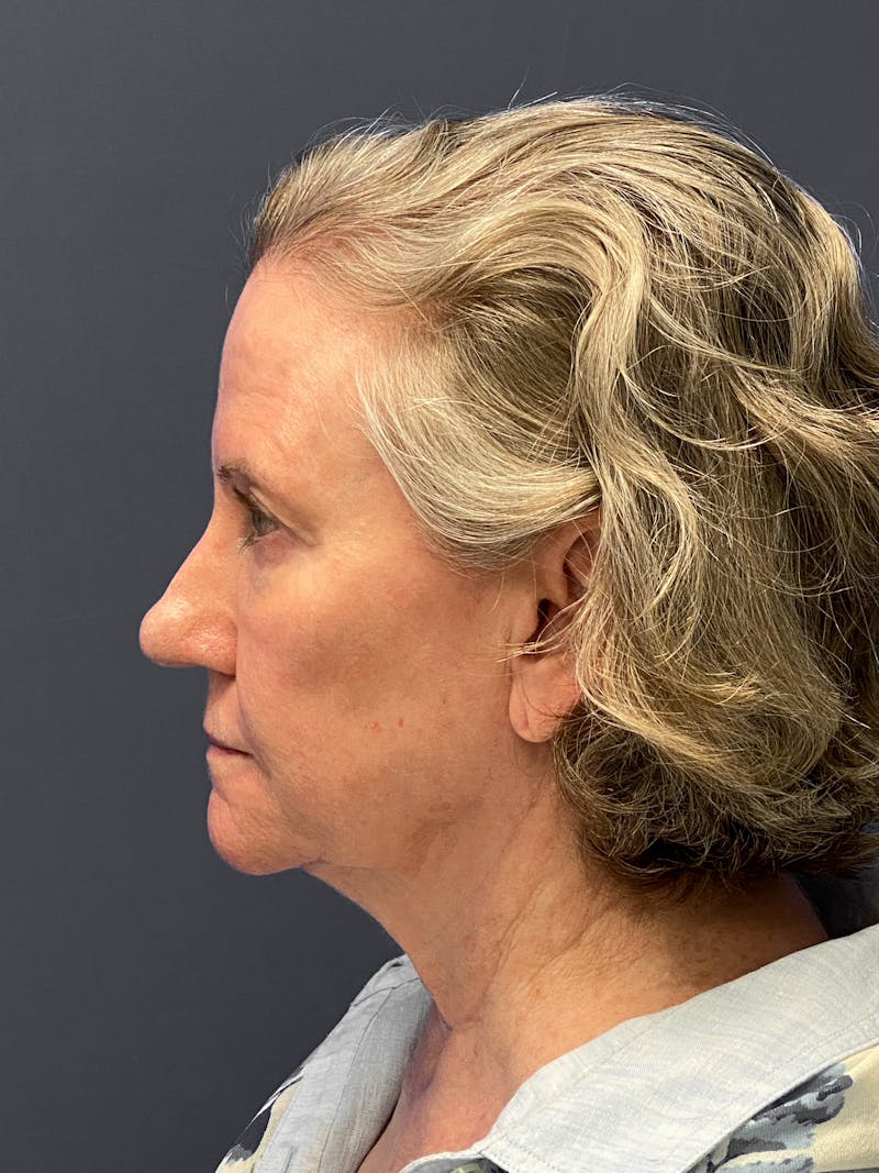 Facial Fat Grafting Before & After Gallery - Patient 133574417 - Image 5