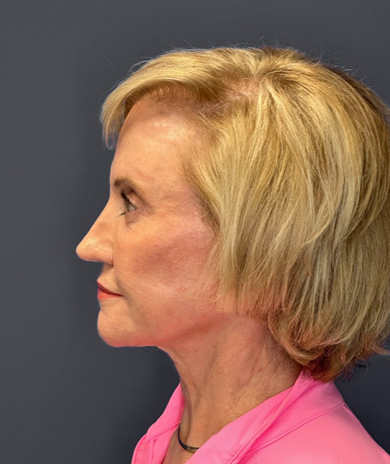 Neck Lift Before & After Gallery - Patient 133574416 - Image 6