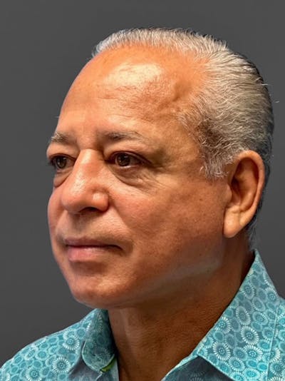 Neck Lift Before & After Gallery - Patient 152861590 - Image 2