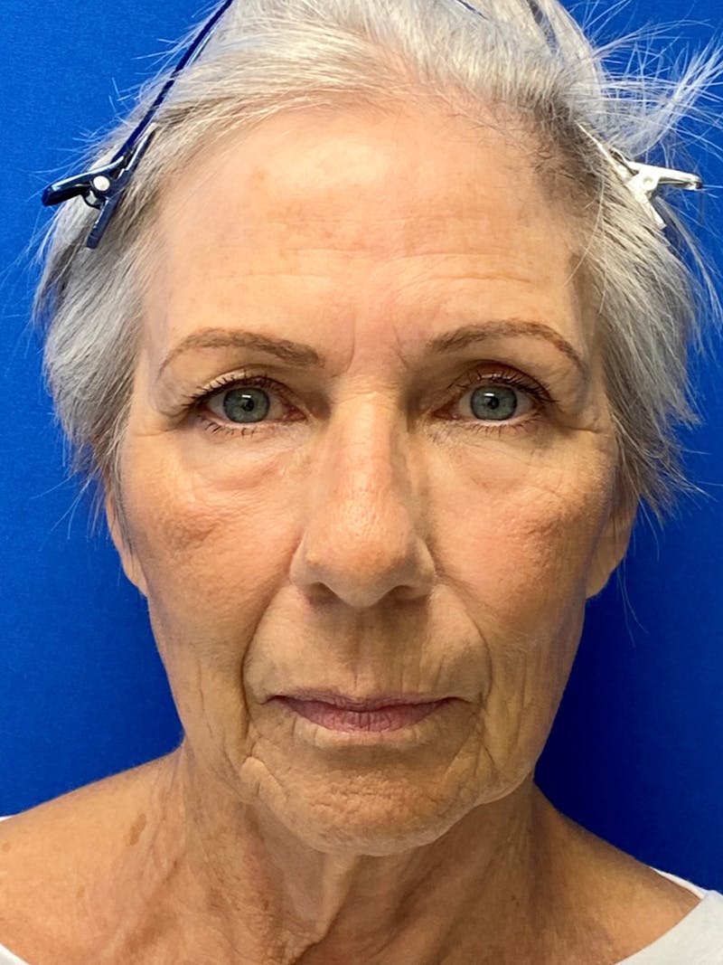 Neck Lift Before & After Gallery - Patient 151995900 - Image 1