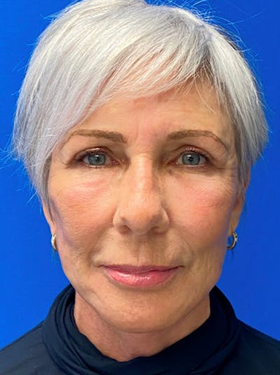 Facelift Before & After Gallery - Patient 151995899 - Image 2