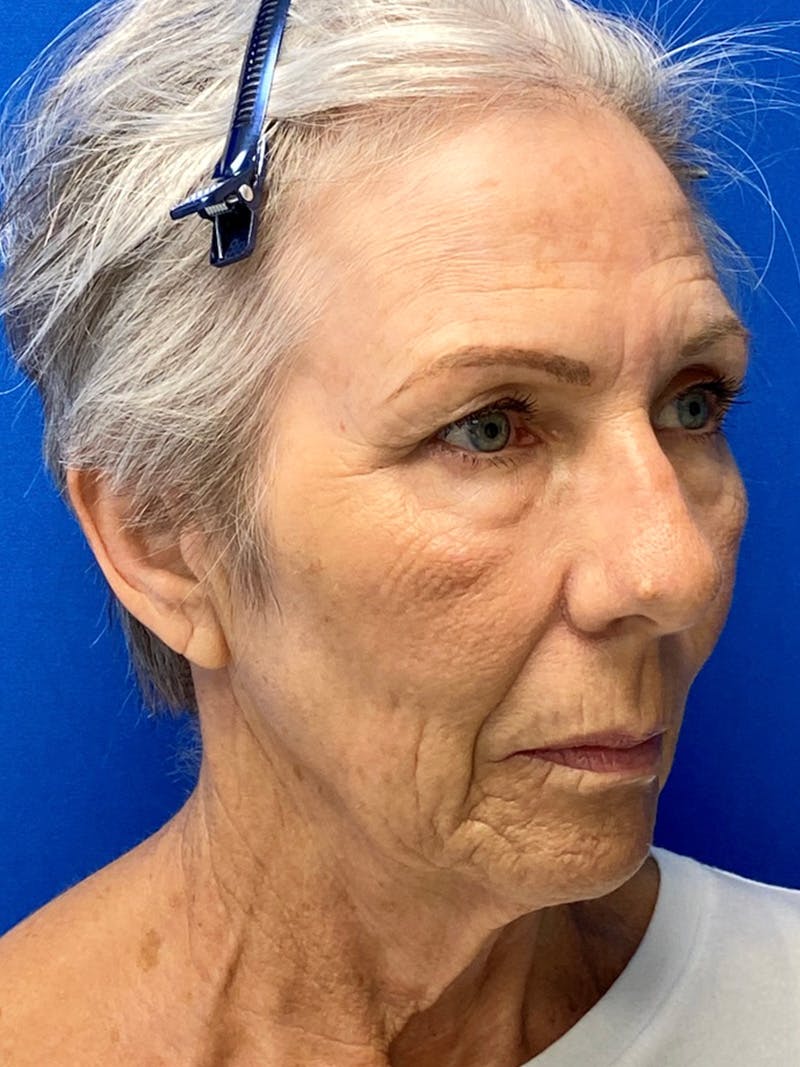 Facelift Before & After Gallery - Patient 151995899 - Image 3