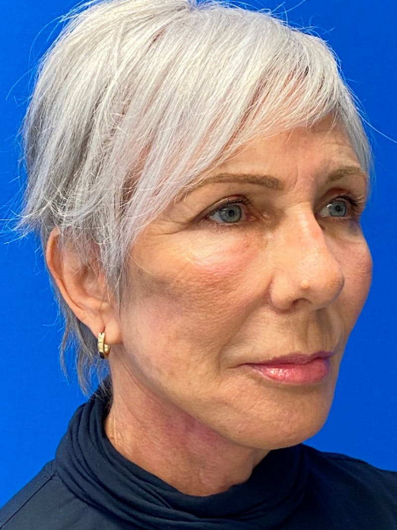 Neck Lift Before & After Gallery - Patient 151995900 - Image 4